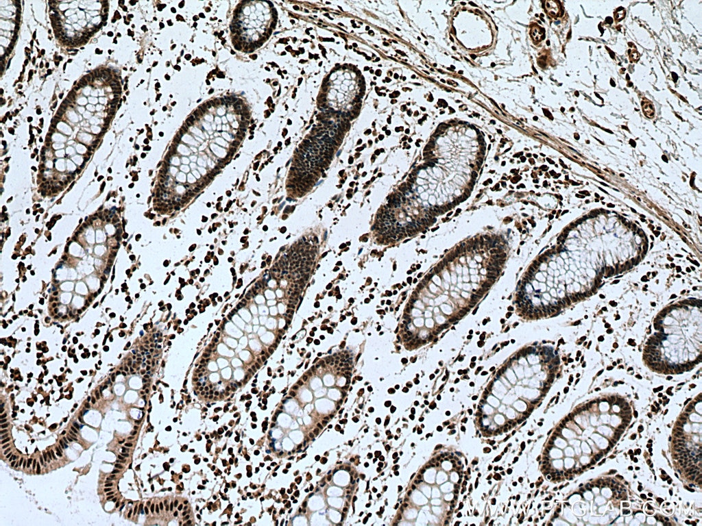 Immunohistochemistry (IHC) staining of human colon cancer tissue using TAF11 Polyclonal antibody (16114-1-AP)