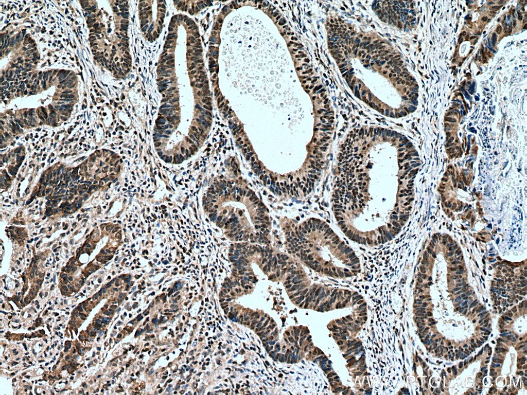 Immunohistochemistry (IHC) staining of human colon cancer tissue using TAF11 Polyclonal antibody (16114-1-AP)