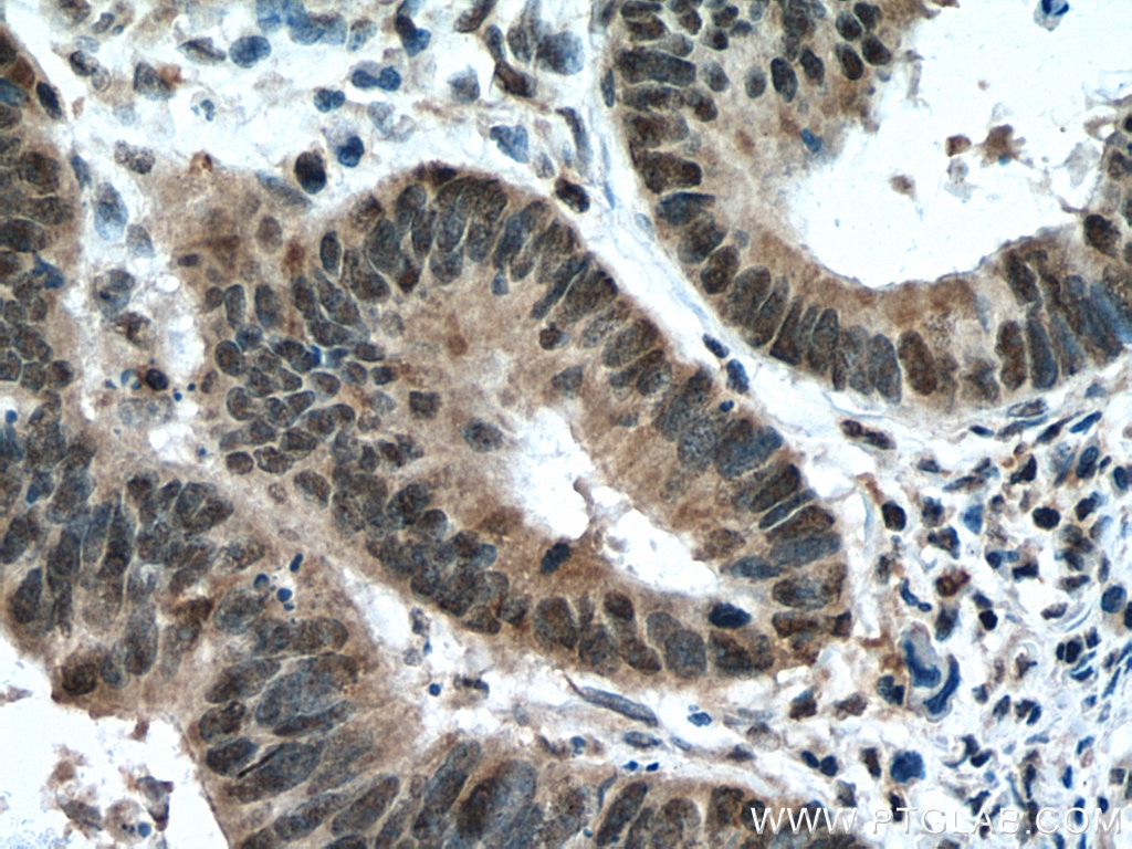 Immunohistochemistry (IHC) staining of human colon cancer tissue using TAF11 Polyclonal antibody (16114-1-AP)