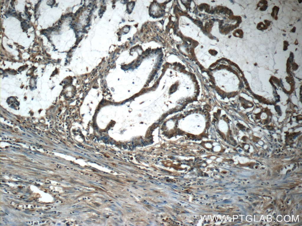 Immunohistochemistry (IHC) staining of human colon cancer tissue using TAF15 Polyclonal antibody (25521-1-AP)