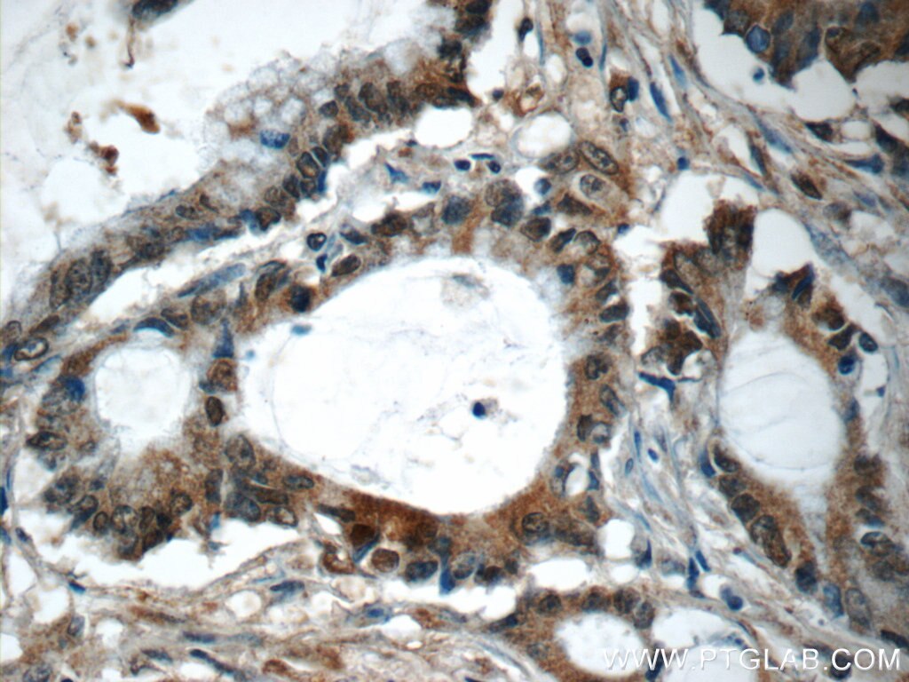 Immunohistochemistry (IHC) staining of human colon cancer tissue using TAF15 Polyclonal antibody (25521-1-AP)