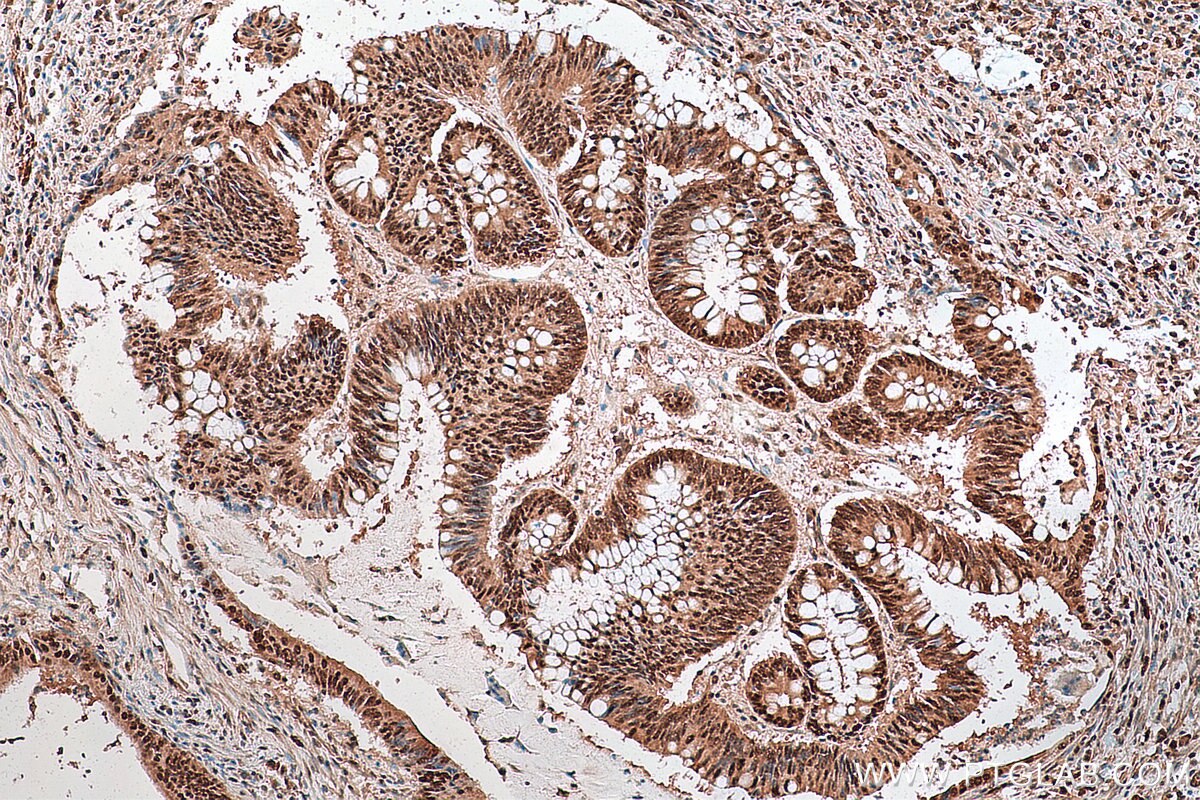 IHC staining of human colon cancer using 25521-1-AP