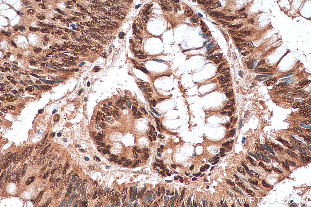 Immunohistochemistry (IHC) staining of human colon cancer tissue using TAF15 Polyclonal antibody (25521-1-AP)