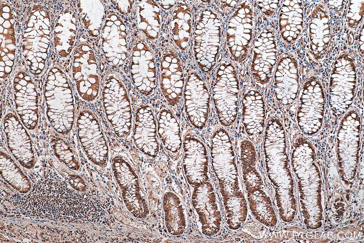 Immunohistochemistry (IHC) staining of human colon cancer tissue using TAF15 Polyclonal antibody (25521-1-AP)