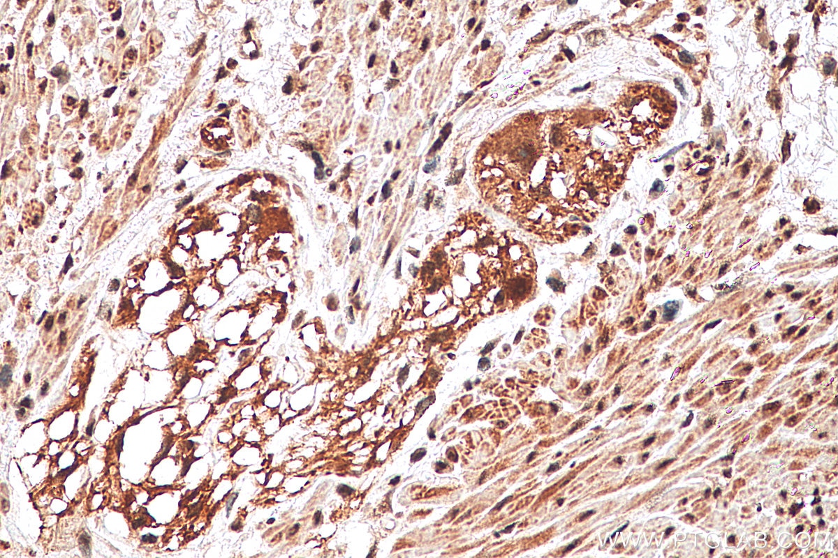 Immunohistochemistry (IHC) staining of human colon cancer tissue using TAF15 Polyclonal antibody (25521-1-AP)