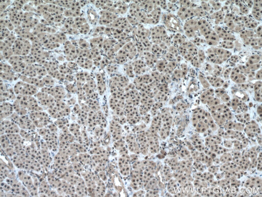 Immunohistochemistry (IHC) staining of human liver cancer tissue using TAF1C Polyclonal antibody (13341-1-AP)