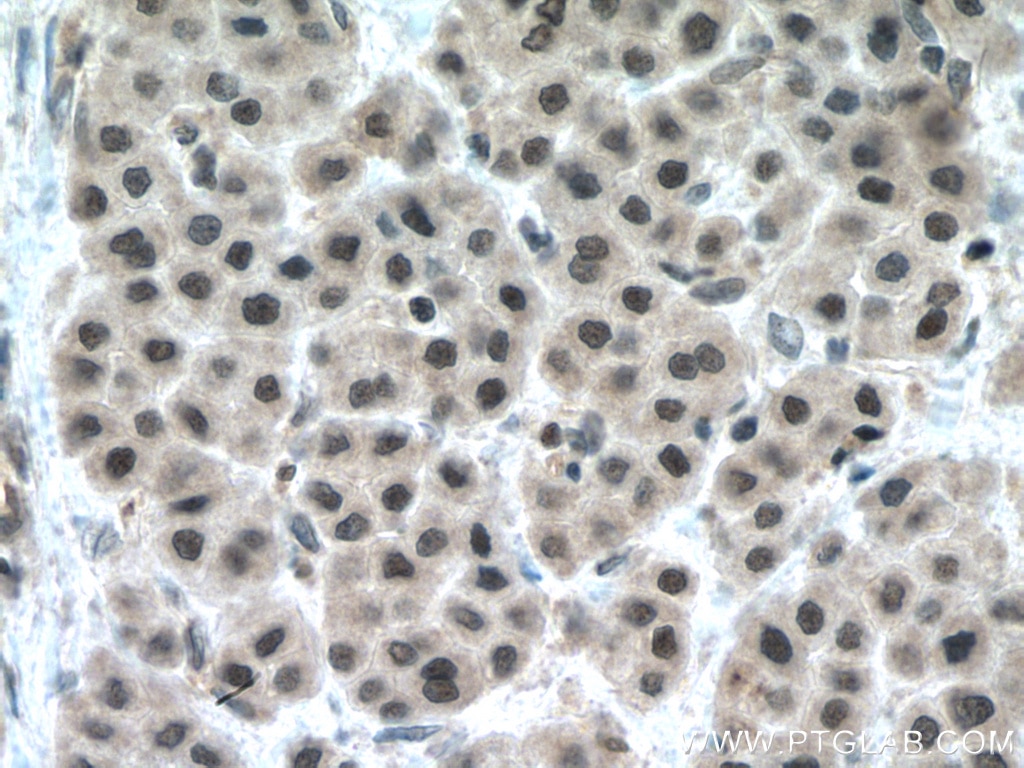 Immunohistochemistry (IHC) staining of human liver cancer tissue using TAF1C Polyclonal antibody (13341-1-AP)