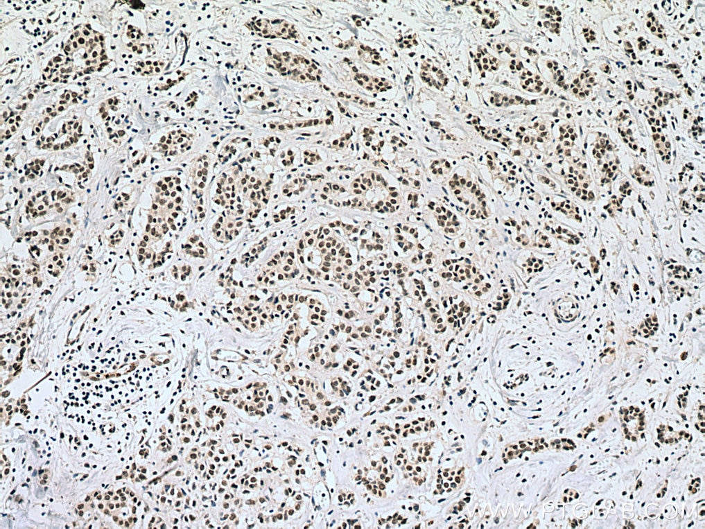 Immunohistochemistry (IHC) staining of human breast cancer tissue using TAF6L Monoclonal antibody (67569-1-Ig)