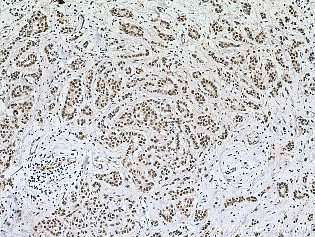 Immunohistochemistry (IHC) staining of human breast cancer tissue using TAF6L Monoclonal antibody (67569-1-Ig)