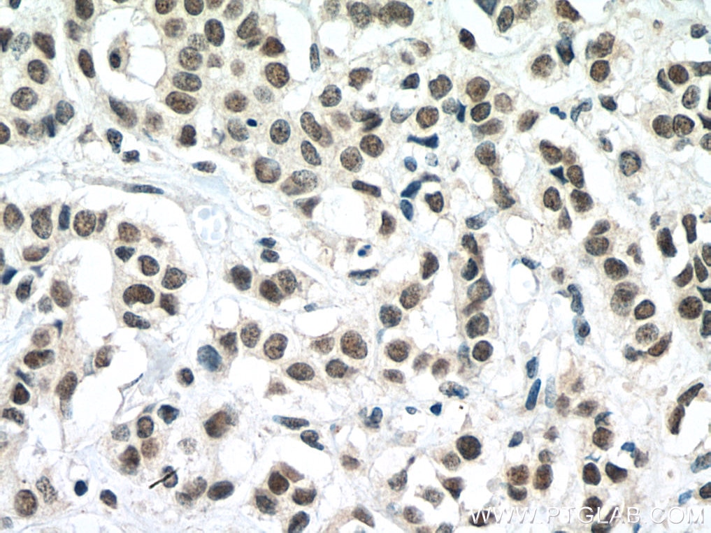 Immunohistochemistry (IHC) staining of human breast cancer tissue using TAF6L Monoclonal antibody (67569-1-Ig)