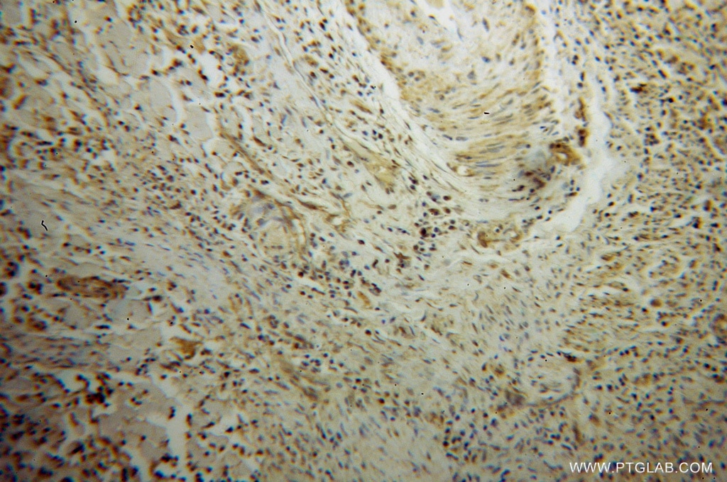 Immunohistochemistry (IHC) staining of human cervical cancer tissue using TAF7 Polyclonal antibody (13506-1-AP)