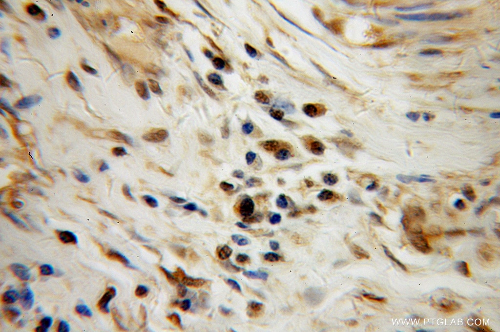 Immunohistochemistry (IHC) staining of human cervical cancer tissue using TAF7 Polyclonal antibody (13506-1-AP)