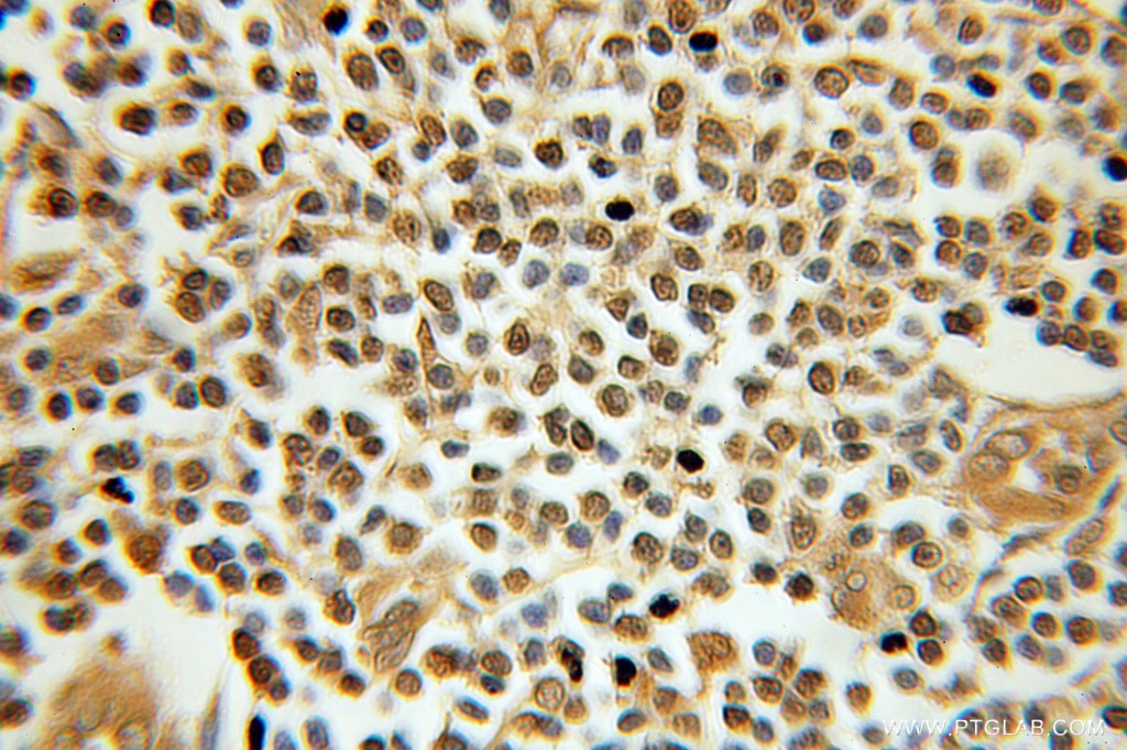 Immunohistochemistry (IHC) staining of human breast cancer tissue using TAF9B Polyclonal antibody (10921-1-AP)