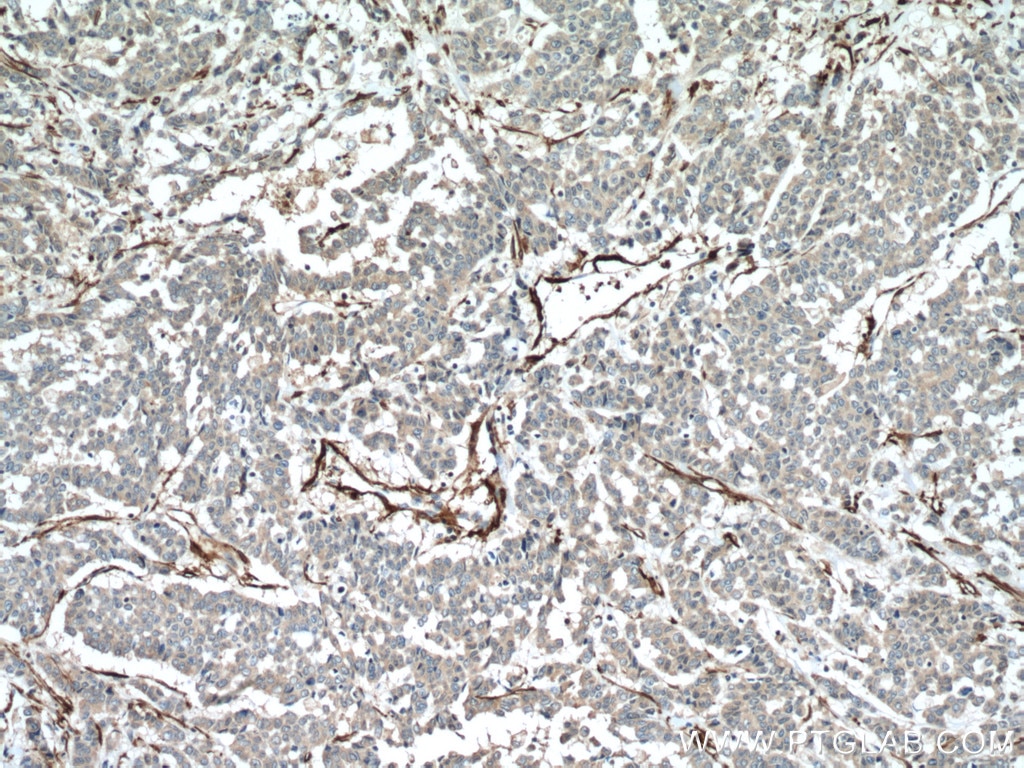 Immunohistochemistry (IHC) staining of human colon cancer tissue using transgelin/SM22 Polyclonal antibody (10493-1-AP)