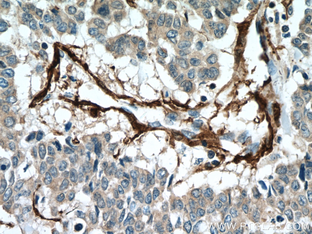Immunohistochemistry (IHC) staining of human colon cancer tissue using transgelin/SM22 Polyclonal antibody (10493-1-AP)