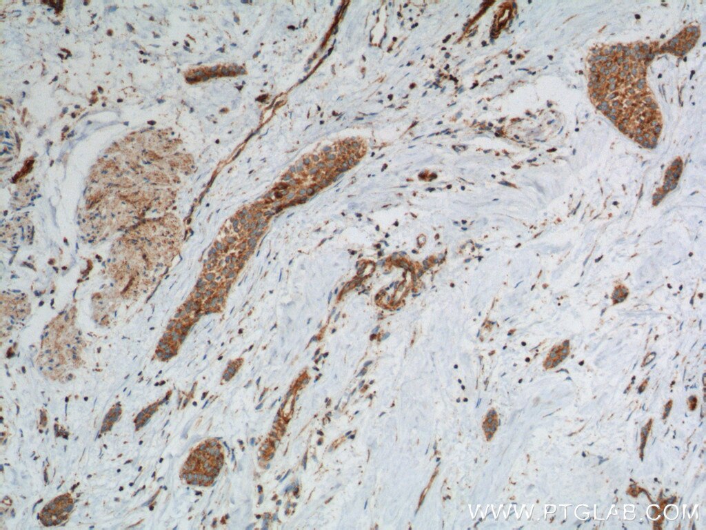 Immunohistochemistry (IHC) staining of human urothelial carcinoma tissue using Transgelin 2 Polyclonal antibody (10234-2-AP)