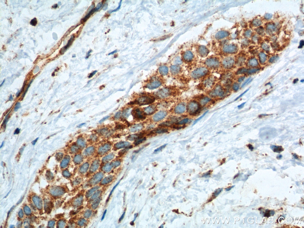 Immunohistochemistry (IHC) staining of human urothelial carcinoma tissue using Transgelin 2 Polyclonal antibody (10234-2-AP)