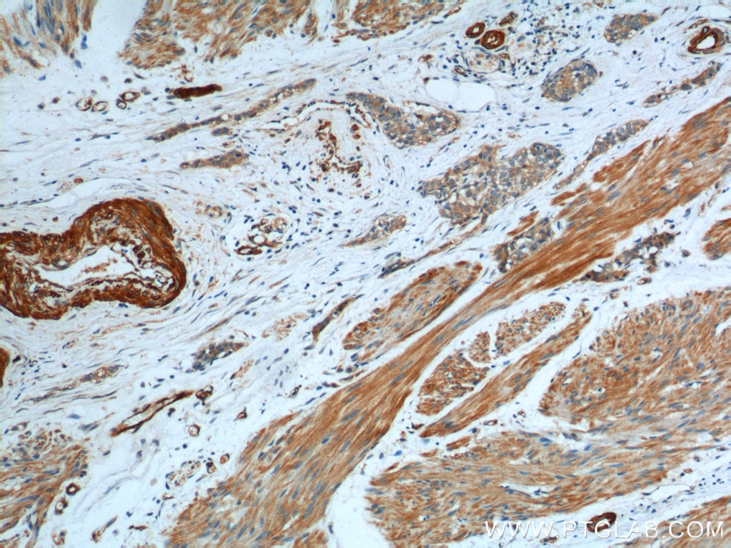 Immunohistochemistry (IHC) staining of human urothelial carcinoma tissue using Transgelin 2 Polyclonal antibody (10234-2-AP)