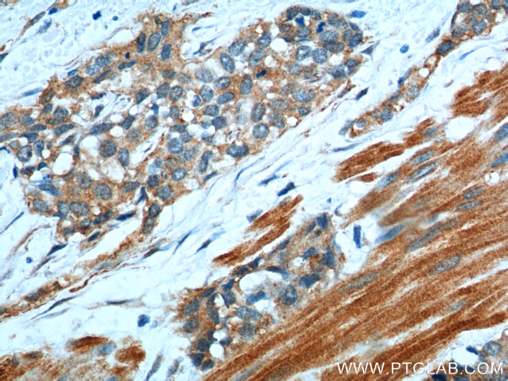 Immunohistochemistry (IHC) staining of human urothelial carcinoma tissue using Transgelin 2 Polyclonal antibody (10234-2-AP)