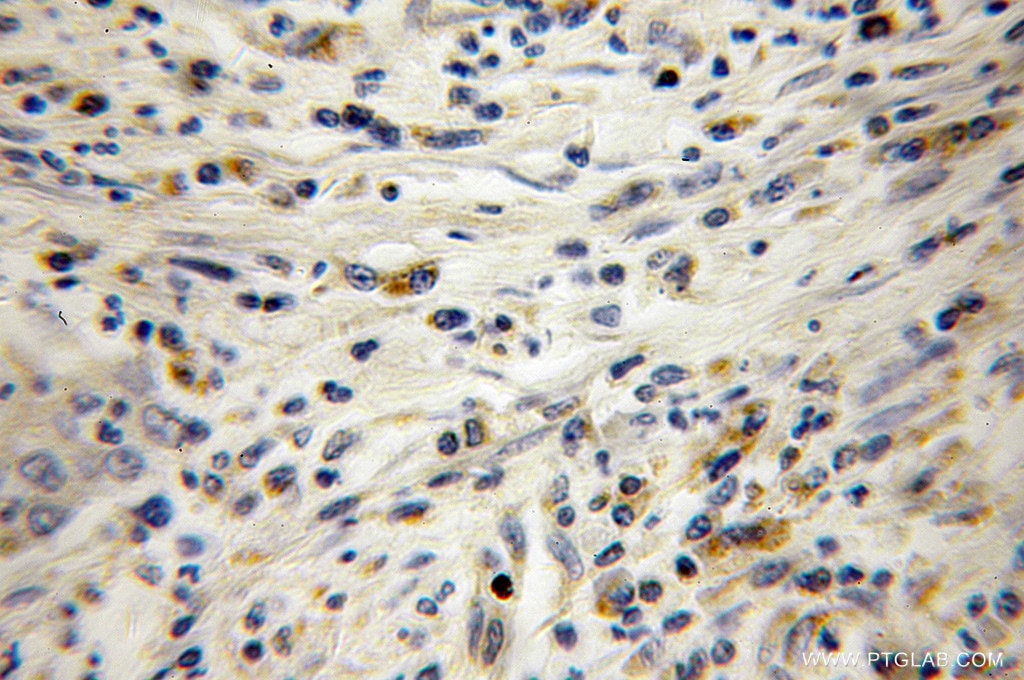 Immunohistochemistry (IHC) staining of human colon cancer tissue using Transgelin 2 Polyclonal antibody (10234-2-AP)