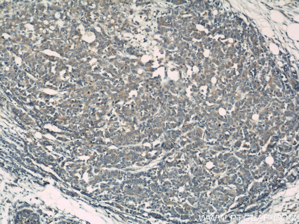 IHC staining of human colon cancer using 10234-2-AP