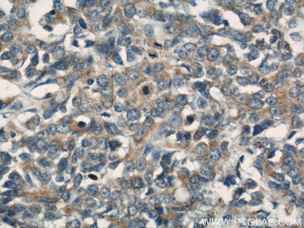 Immunohistochemistry (IHC) staining of human colon cancer tissue using Transgelin 2 Polyclonal antibody (10234-2-AP)