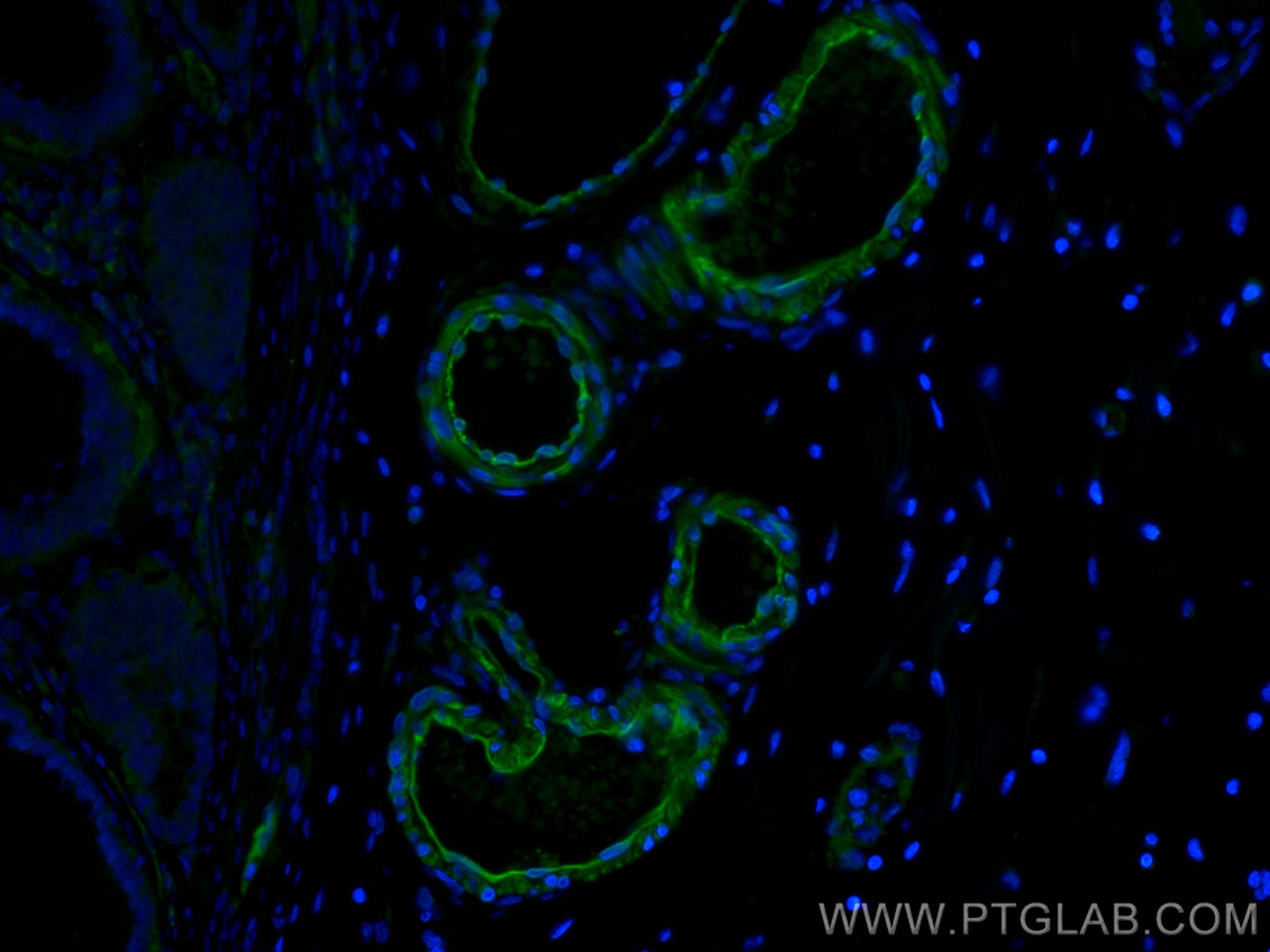 Immunofluorescence (IF) / fluorescent staining of human colon cancer tissue using Transgelin 2 Monoclonal antibody (60044-1-Ig)