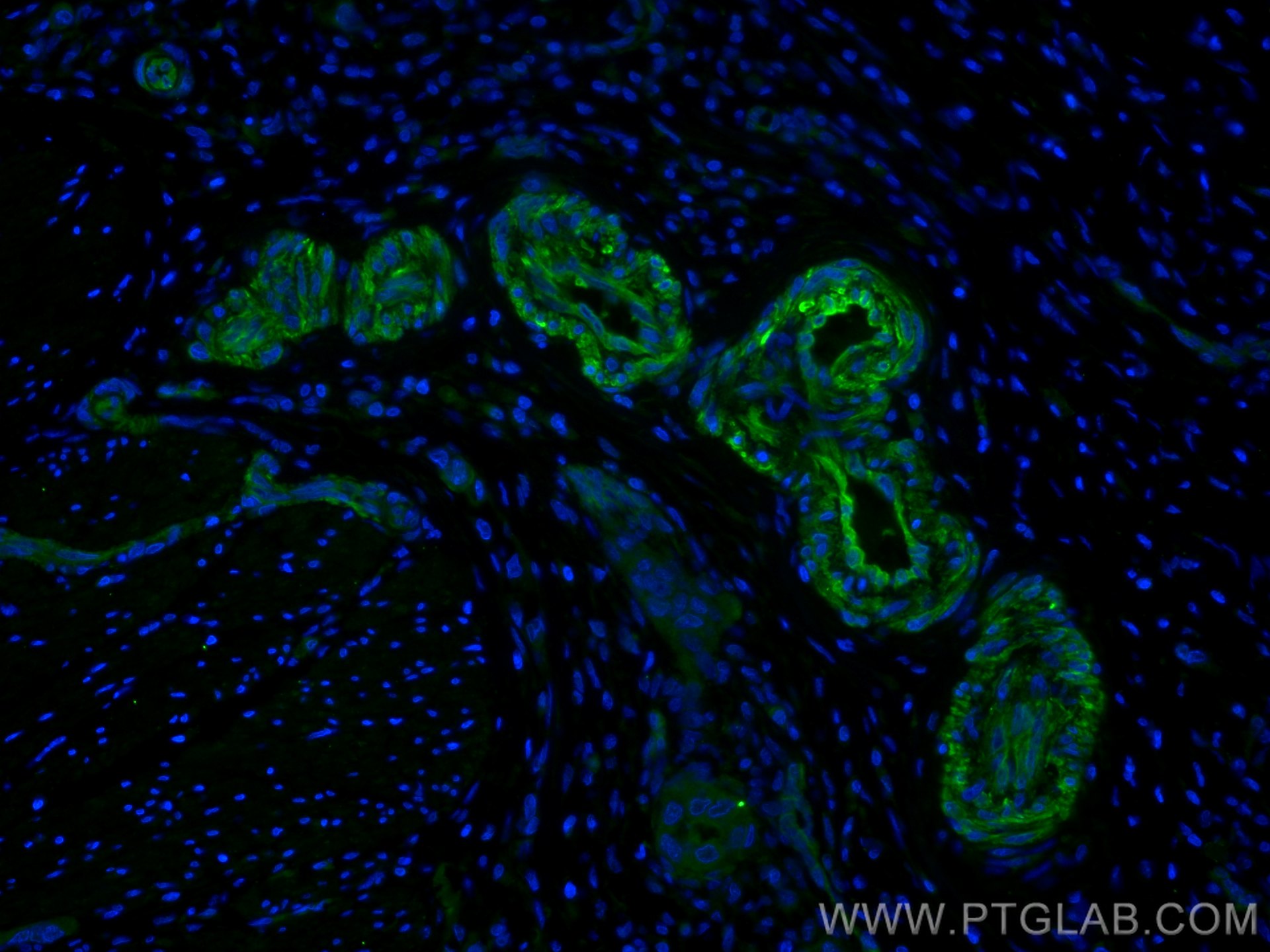 Immunofluorescence (IF) / fluorescent staining of human colon cancer tissue using Transgelin 2 Monoclonal antibody (60044-1-Ig)