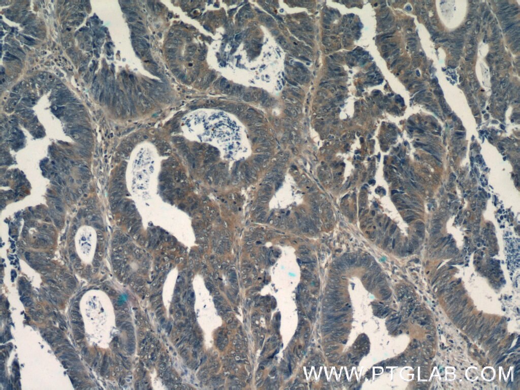 IHC staining of human colon cancer using 60044-1-Ig
