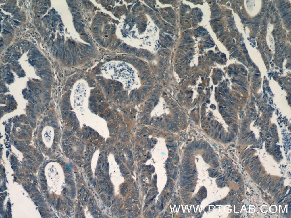 Immunohistochemistry (IHC) staining of human colon cancer tissue using Transgelin 2 Monoclonal antibody (60044-1-Ig)