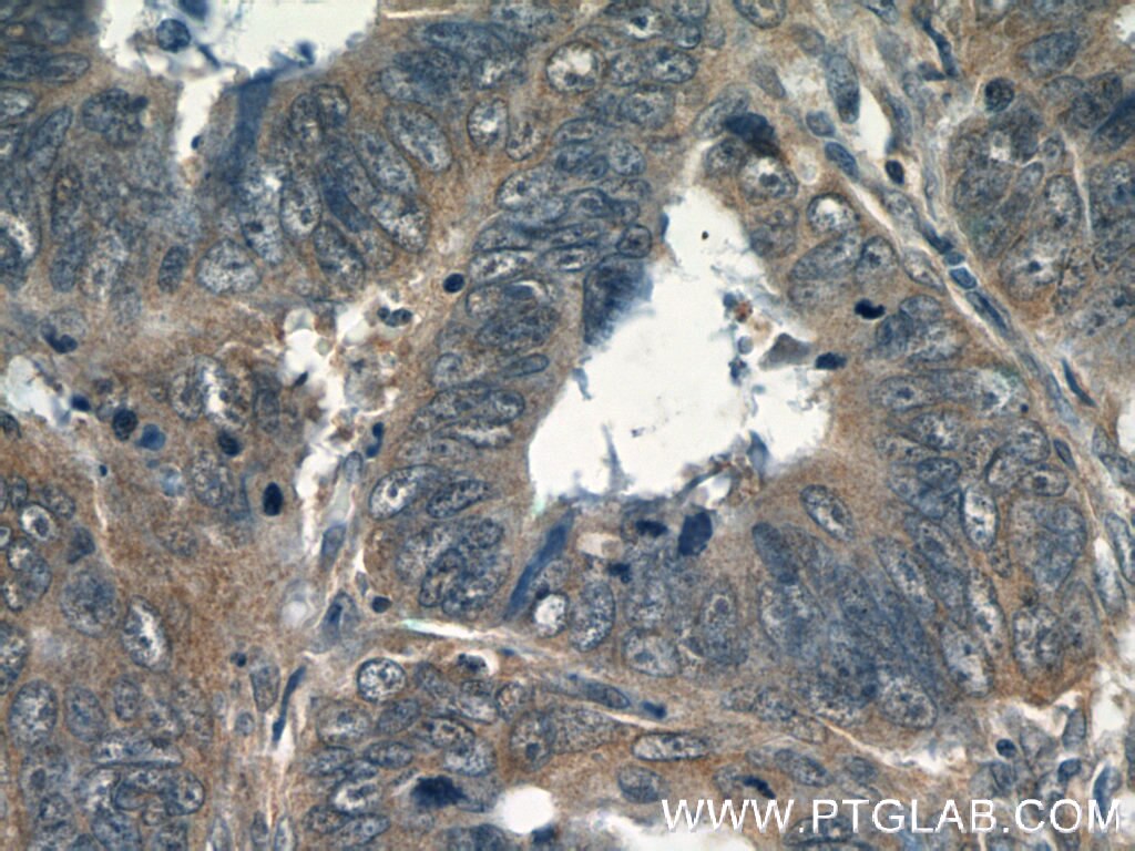 Immunohistochemistry (IHC) staining of human colon cancer tissue using Transgelin 2 Monoclonal antibody (60044-1-Ig)