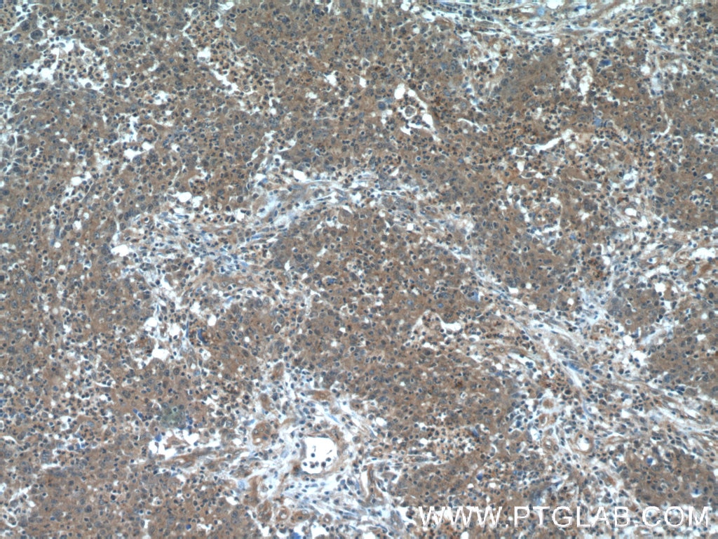 Immunohistochemistry (IHC) staining of human colon cancer tissue using Transgelin 2 Monoclonal antibody (60044-1-Ig)