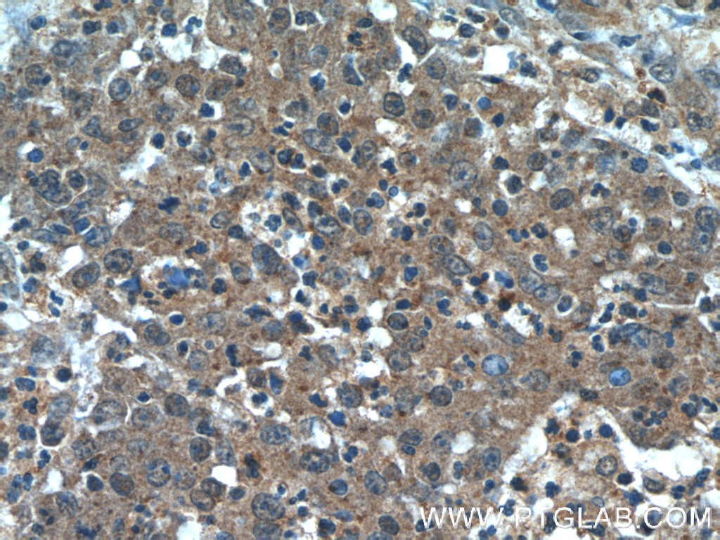 Immunohistochemistry (IHC) staining of human colon cancer tissue using Transgelin 2 Monoclonal antibody (60044-1-Ig)
