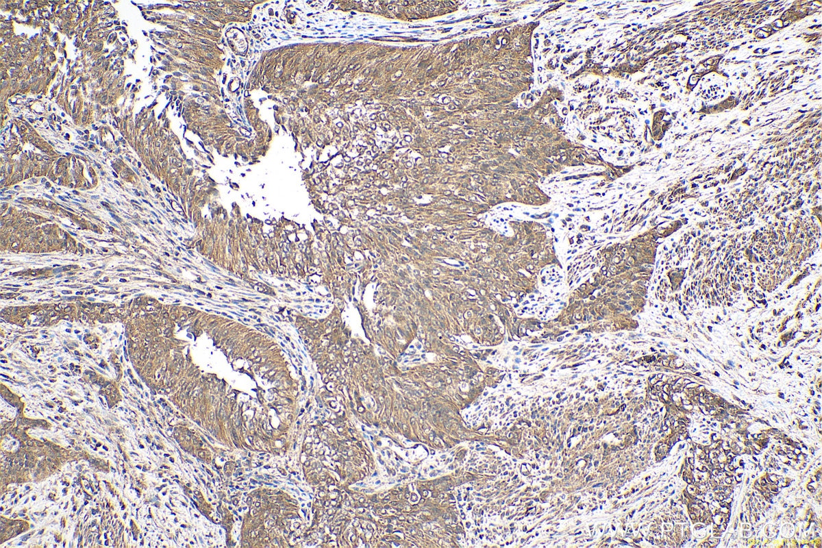 Immunohistochemistry (IHC) staining of human urothelial carcinoma tissue using Transgelin 2 Monoclonal antibody (60044-1-Ig)