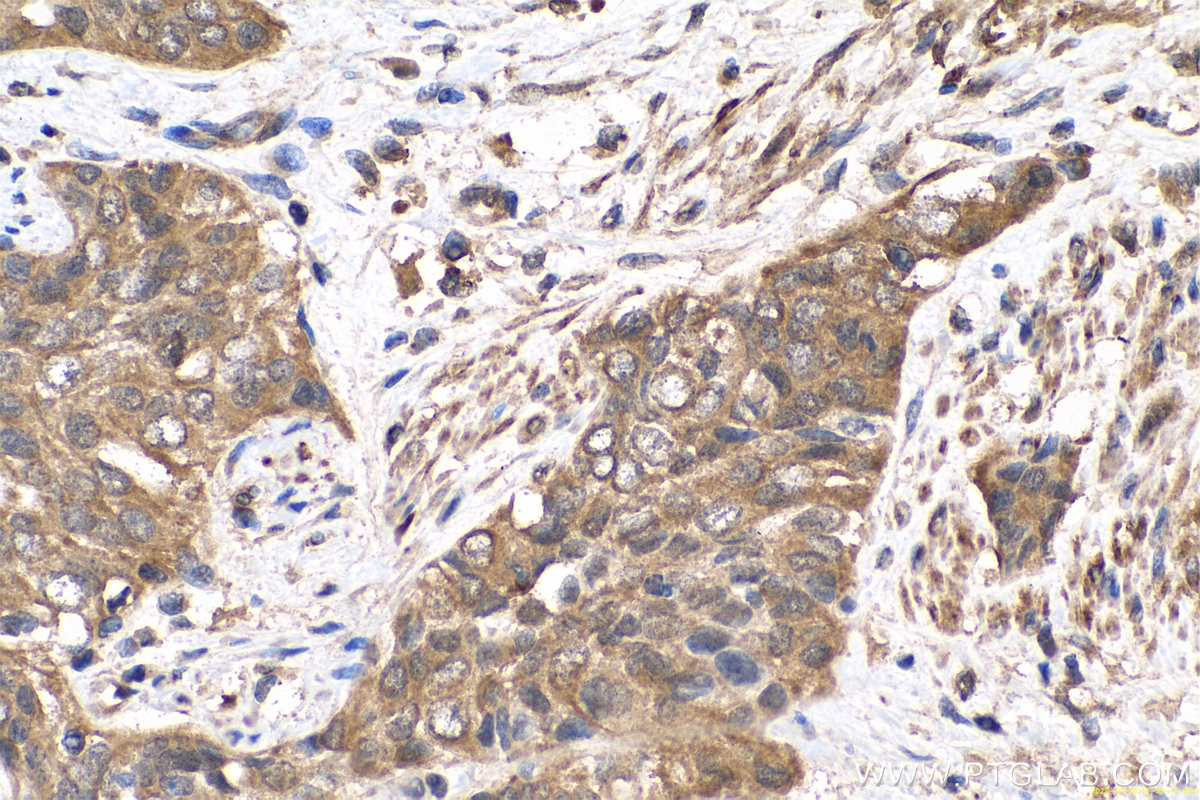 Immunohistochemistry (IHC) staining of human urothelial carcinoma tissue using Transgelin 2 Monoclonal antibody (60044-1-Ig)