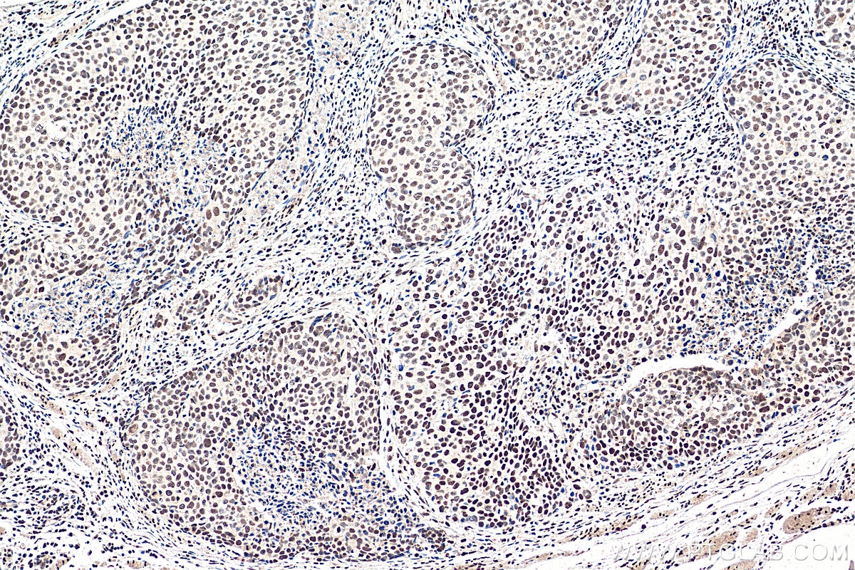 Immunohistochemistry (IHC) staining of human oesophagus cancer tissue using TALDO1 Monoclonal antibody (67816-1-Ig)