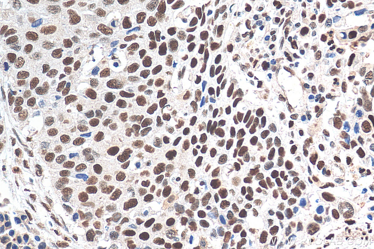 Immunohistochemistry (IHC) staining of human oesophagus cancer tissue using TALDO1 Monoclonal antibody (67816-1-Ig)