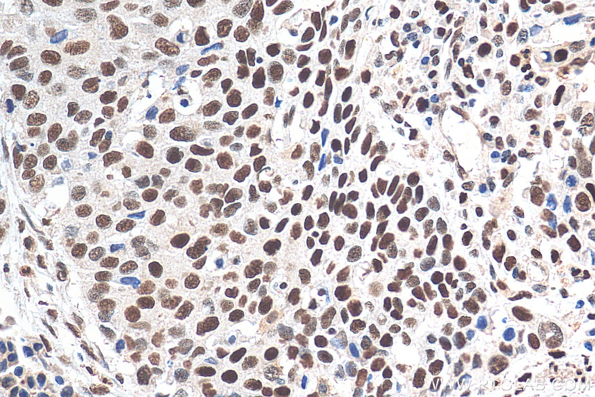 Immunohistochemistry (IHC) staining of human oesophagus cancer tissue using TALDO1 Monoclonal antibody (67816-1-Ig)