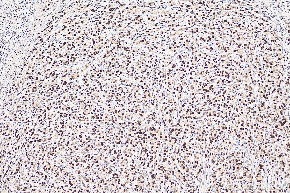 Immunohistochemistry (IHC) staining of human prostate cancer tissue using TALDO1 Monoclonal antibody (67816-1-Ig)