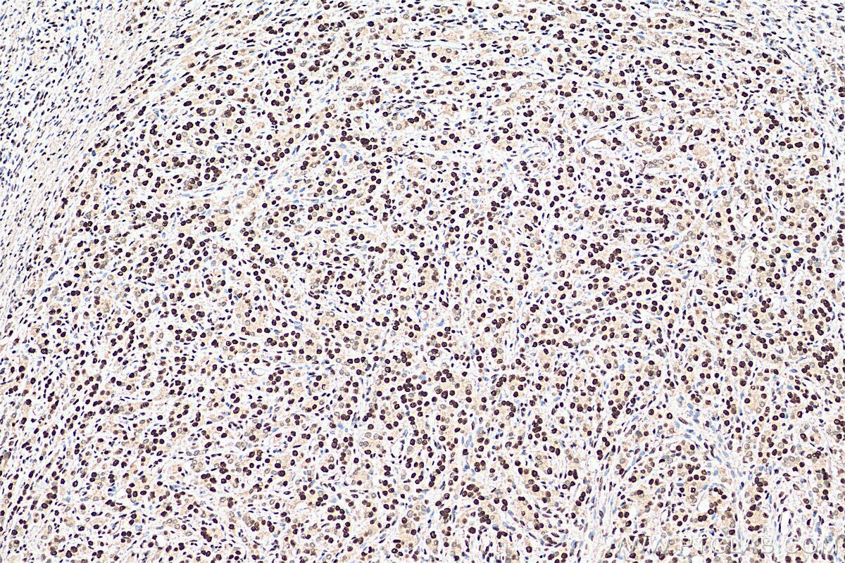 Immunohistochemistry (IHC) staining of human prostate cancer tissue using TALDO1 Monoclonal antibody (67816-1-Ig)
