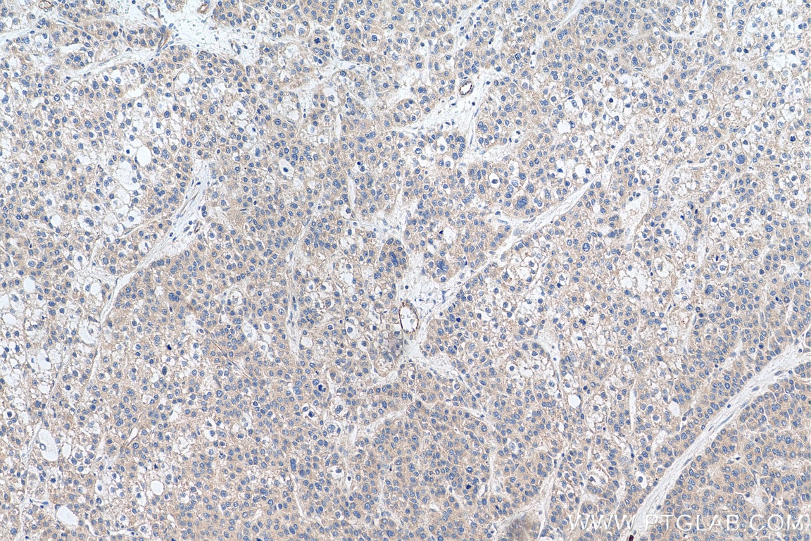 Immunohistochemistry (IHC) staining of human liver cancer tissue using TAOK2 Polyclonal antibody (21188-1-AP)