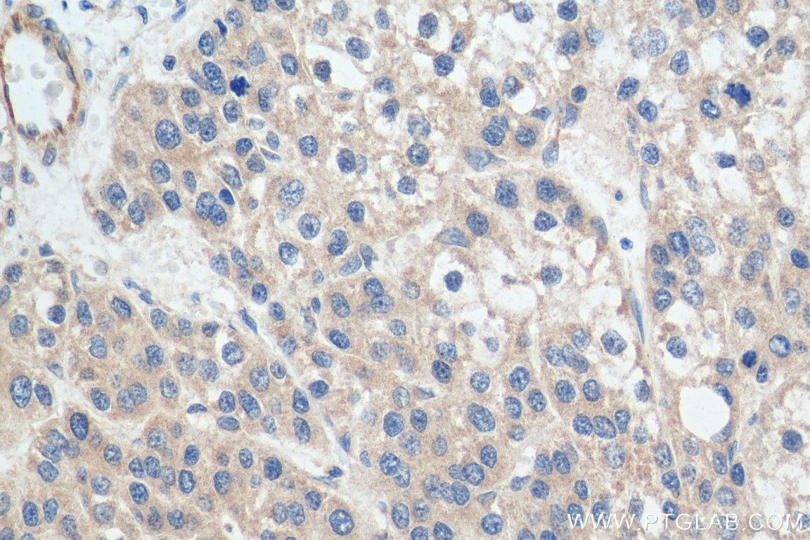 Immunohistochemistry (IHC) staining of human liver cancer tissue using TAOK2 Polyclonal antibody (21188-1-AP)
