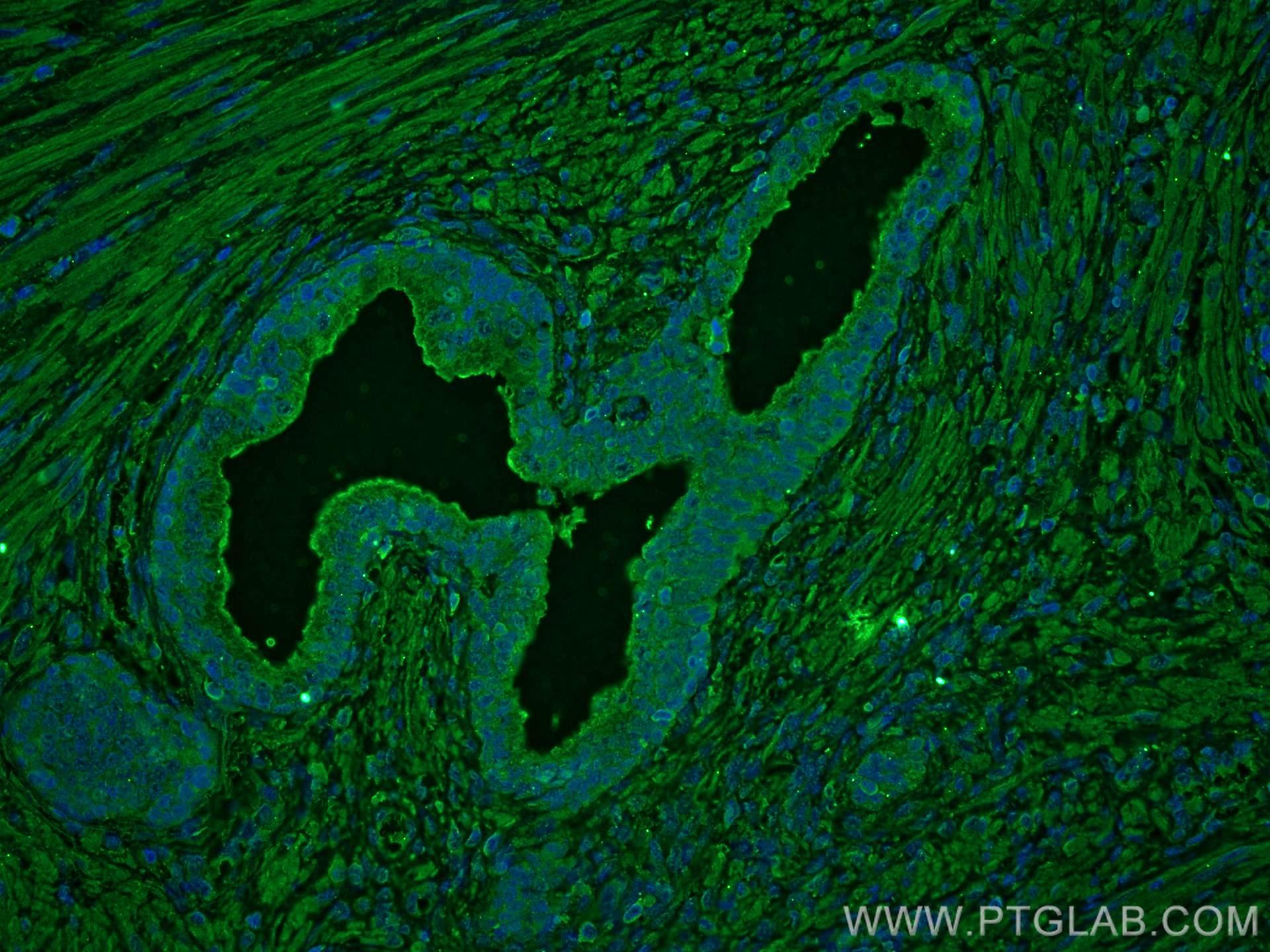 Immunofluorescence (IF) / fluorescent staining of human prostate cancer tissue using TAOK3 Monoclonal antibody (67451-1-Ig)