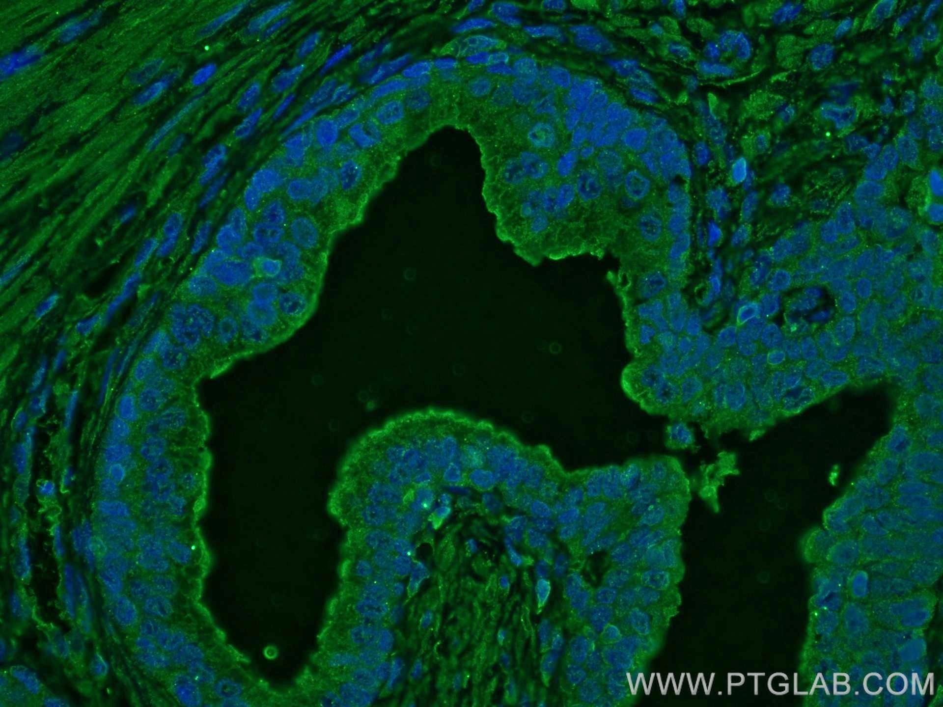 Immunofluorescence (IF) / fluorescent staining of human prostate cancer tissue using TAOK3 Monoclonal antibody (67451-1-Ig)