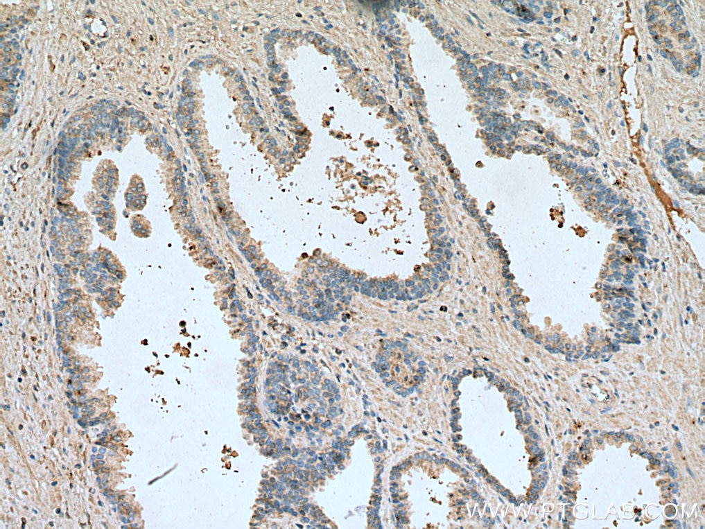 IHC staining of human prostate cancer using 67451-1-Ig