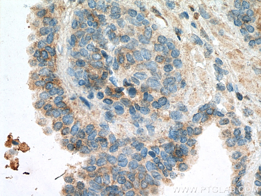 Immunohistochemistry (IHC) staining of human prostate cancer tissue using TAOK3 Monoclonal antibody (67451-1-Ig)