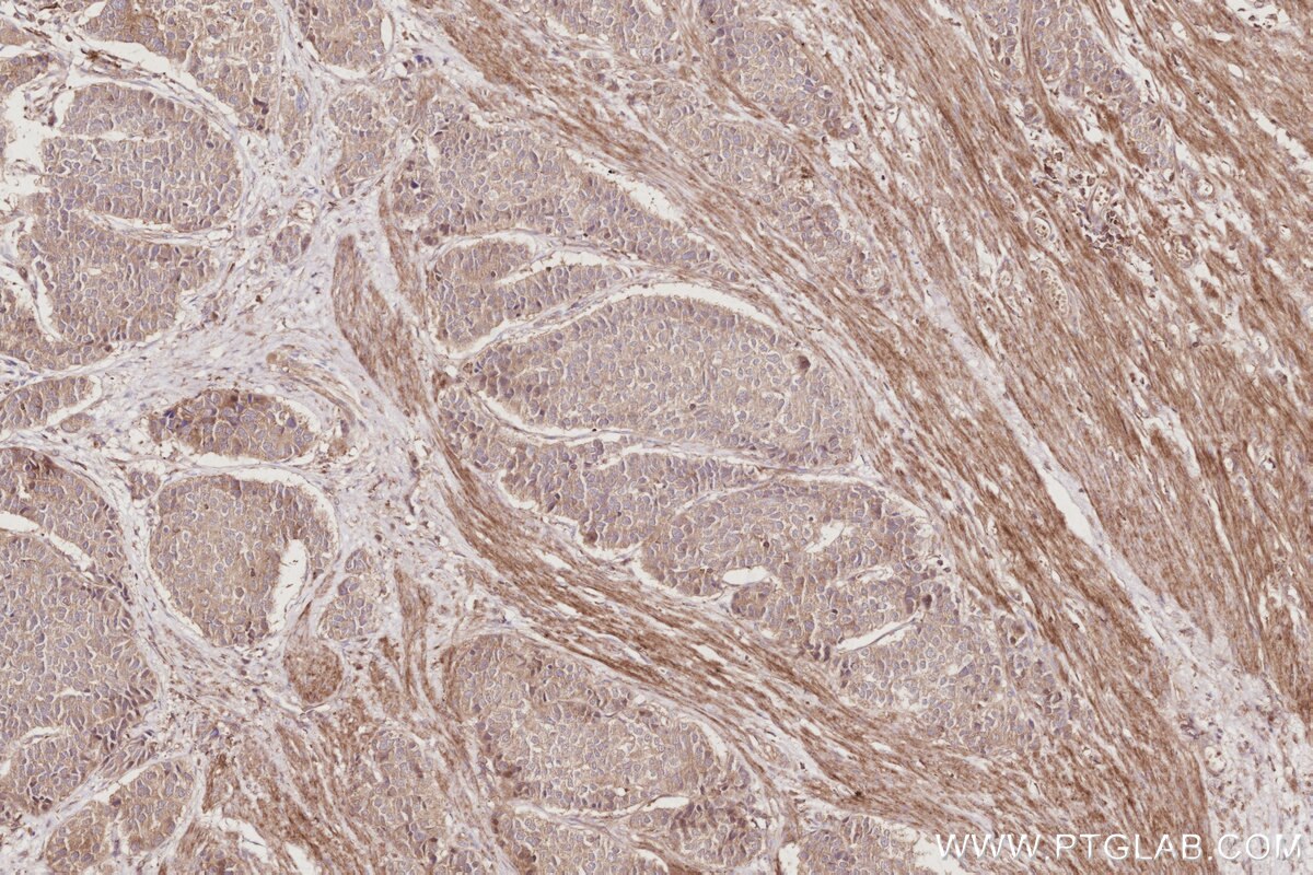 Immunohistochemistry (IHC) staining of human stomach cancer tissue using TAOK3 Monoclonal antibody (67451-1-Ig)