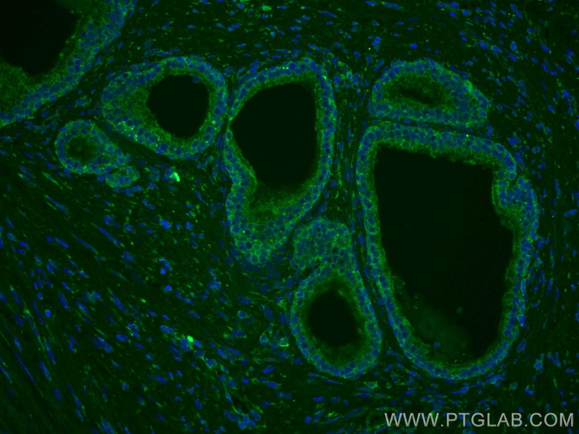 Immunofluorescence (IF) / fluorescent staining of human prostate cancer tissue using CoraLite® Plus 488-conjugated TAOK3 Monoclonal ant (CL488-67451)