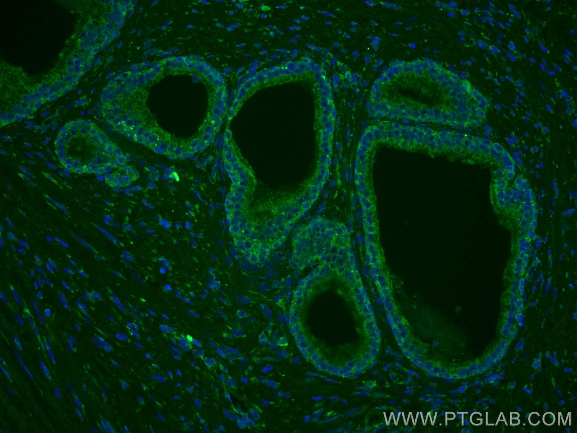 Immunofluorescence (IF) / fluorescent staining of human prostate cancer tissue using CoraLite® Plus 488-conjugated TAOK3 Monoclonal ant (CL488-67451)