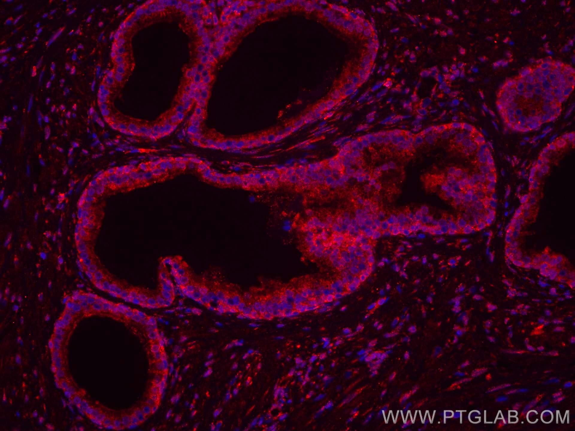 IF Staining of human prostate cancer using CL594-67451